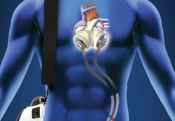 an artificial heart graphic